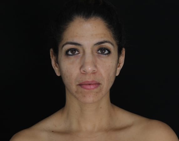 Before Belotero Balance & Radiesse treatment, Subject 1