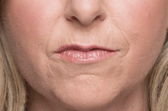 Before Belotero Balance & Radiesse treatment, Subject 2