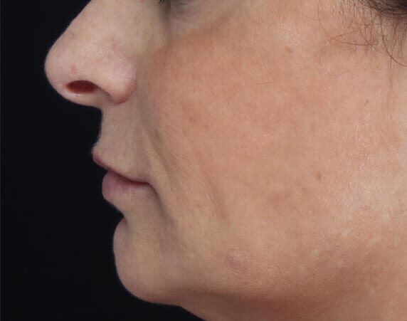 Filler treatment with Juvederm VolumaXC, subject 1 after treatment