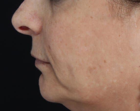 Filler treatment with Juvederm VolumaXC, subject 1 before treatment