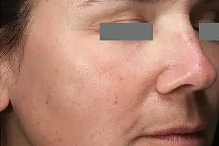 After Nordlys SWT treatment, Subject 1