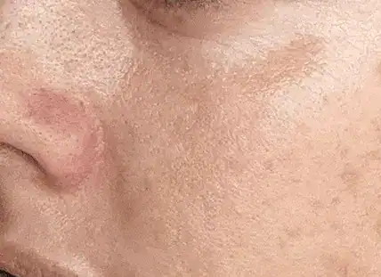 After Nordlys SWT treatment, Subject 4