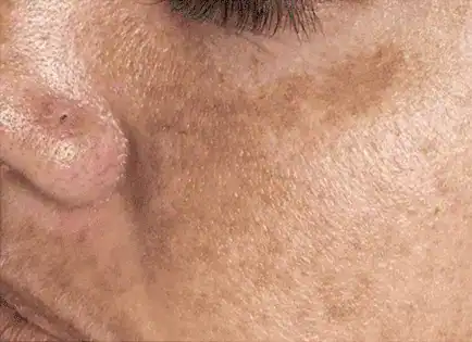 Before Nordlys SWT treatment, Subject 4