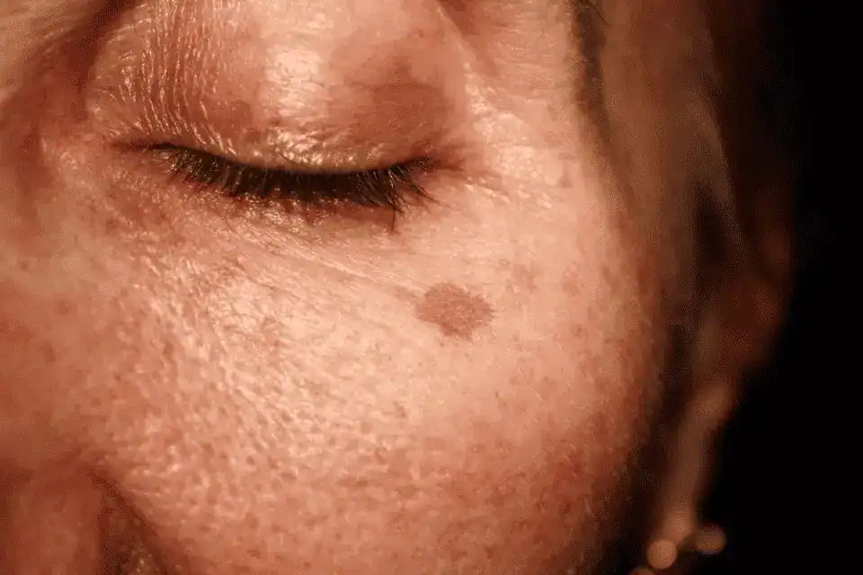 Woman with freckles and age spots from sun damage