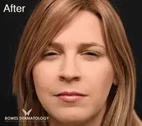 After Botox treatment, Subject 1, photo 1