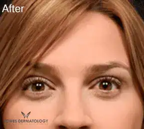 After Botox treatment, Subject 1, photo 2