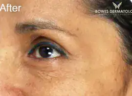 After Botox treatment, Subject 3, photo 3 (crow's feet)