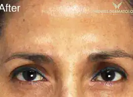 After Botox treatment, Subject 3, photo 1 (frowning)