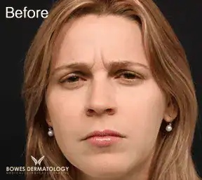 Before Botox treatment, Subject 1, photo 1