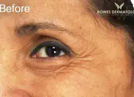 Before Botox treatment, Subject 3, photo 3 (crow's feet)