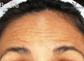 Before Botox treatment, Subject 3, photo 2 (front)