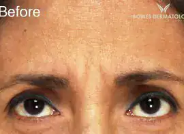 Before Botox treatment, Subject 3, photo 1 (frowning)