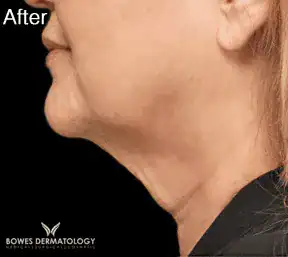 After Botox treatment to neck, Subject 2, photo 1