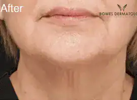 After Botox treatment to neck, Subject 2, photo 2