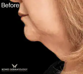 Before Botox treatment to neck, Subject 2, photo 1