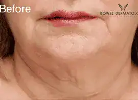 Before Botox treatment to neck, Subject 2, photo 2