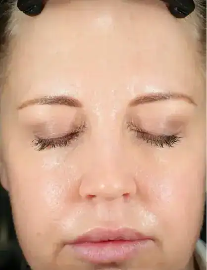 After CoolPeel treatment, Subject 2