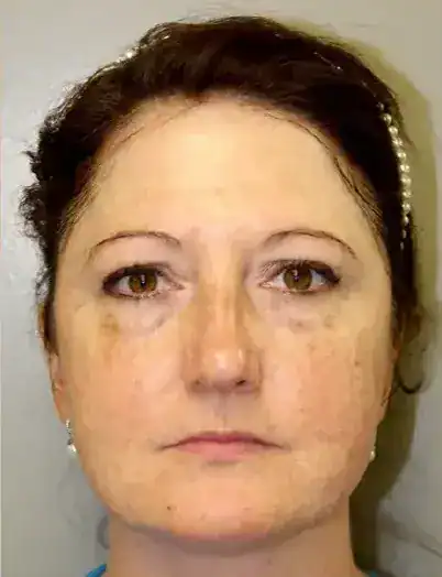 Before CoolPeel treatment, Subject 1