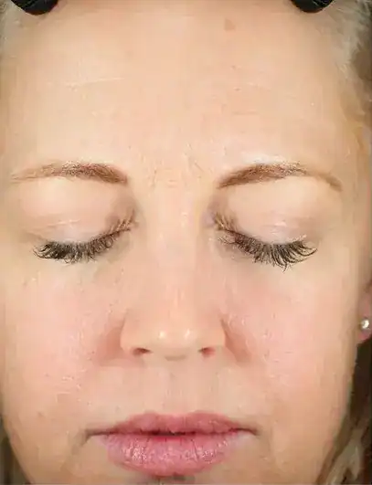 Before CoolPeel treatment, Subject 2