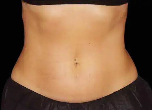 After Emsculpt treatment, Subject 2