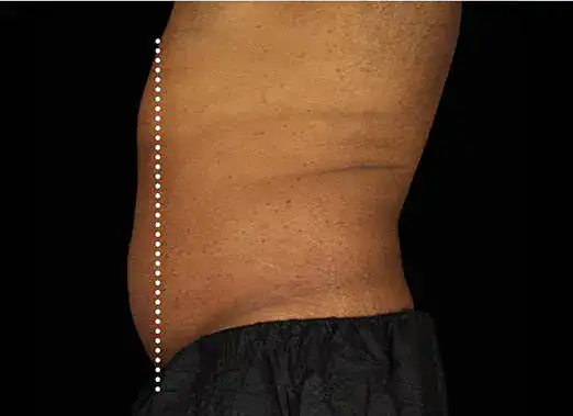 After Emsculpt treatment, Subject 4