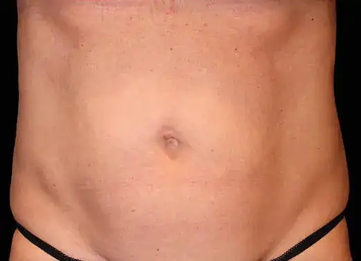 After Emsculpt treatment, Subject 6