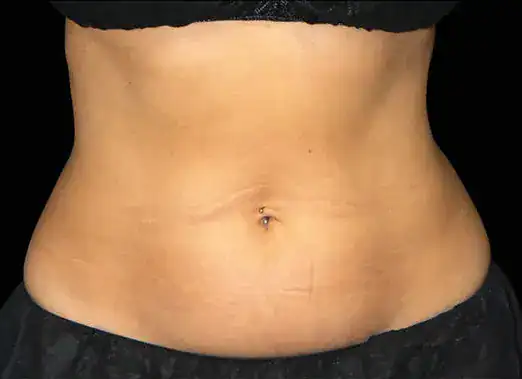 Before Emsculpt treatment, Subject 2