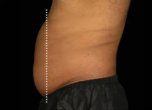 Before Emsculpt treatment, Subject 4