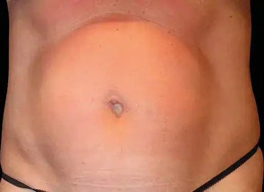 Before Emsculpt treatment, Subject 6