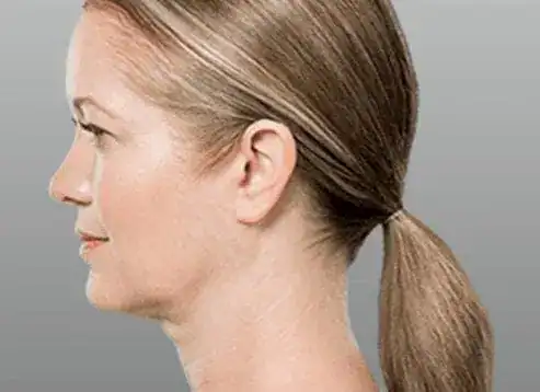 After Kybella treatment, Subject 1