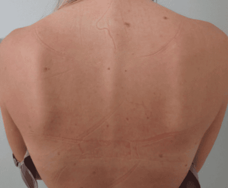 After Moxi + BBL treatment, Subject 1