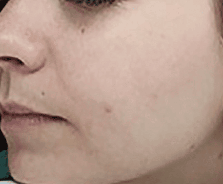 After Moxi + BBL treatment, Subject 2