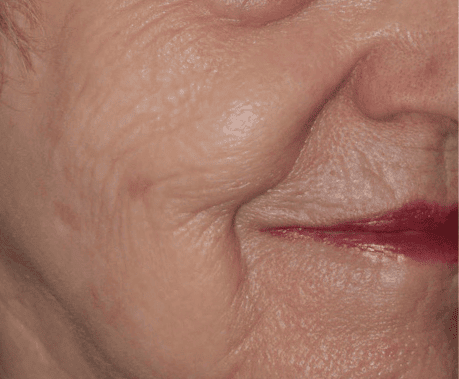 After Moxi + BBL treatment, Subject 3