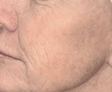 After Moxi + BBL treatment, Subject 4