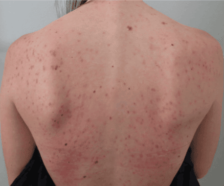 Before Moxi + BBL treatment, Subject 1