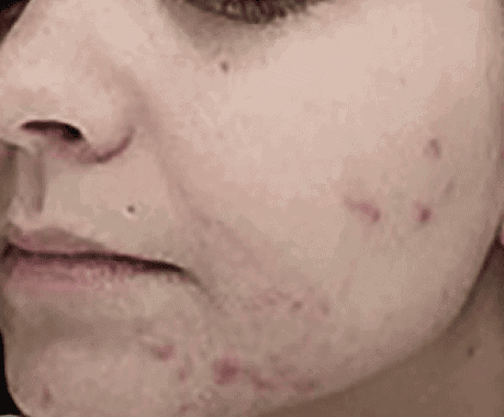 Before Moxi + BBL treatment, Subject 2