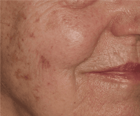 Before Moxi + BBL treatment, Subject 3