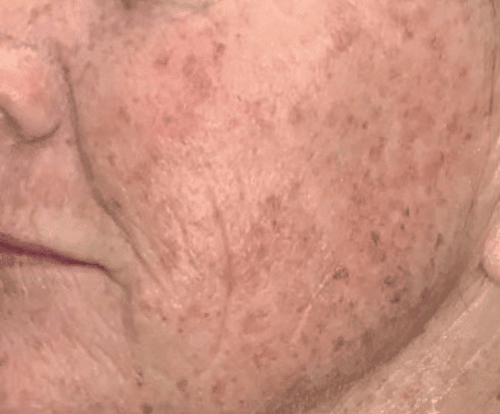 Before Moxi + BBL treatment, Subject 4