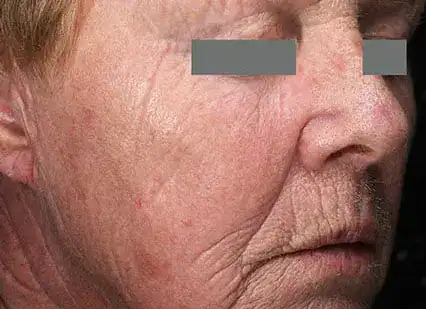 After Nordlys fractional laser resurfacing, Subject 1