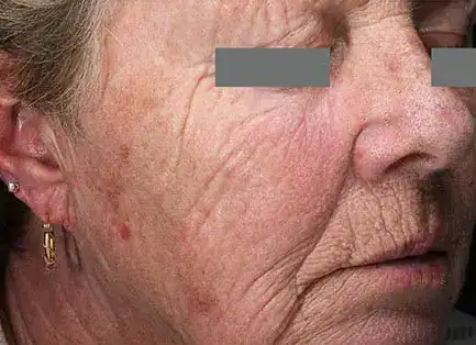 Before Nordlys fractional laser resurfacing, Subject 1