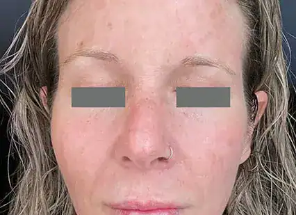 After Nordlys Light & Bright treatment, Subject 2