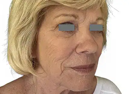 After Nordlys Light & Bright treatment, Subject 3