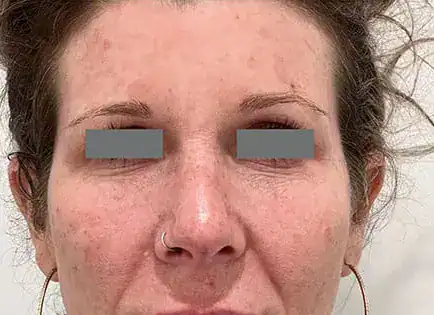 Before Nordlys Light & Bright treatment, Subject 2