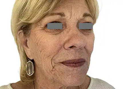 Before Nordlys Light & Bright treatment, Subject 3