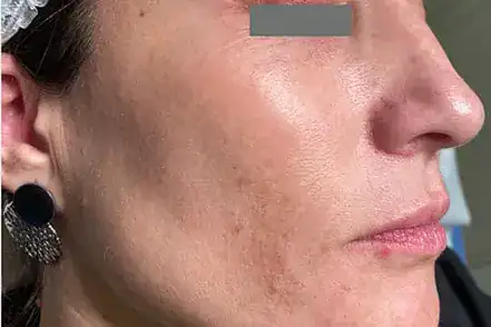 After Nordlys SWT treatment, Subject 2