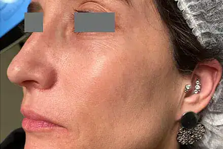 After Nordlys SWT treatment, Subject 3