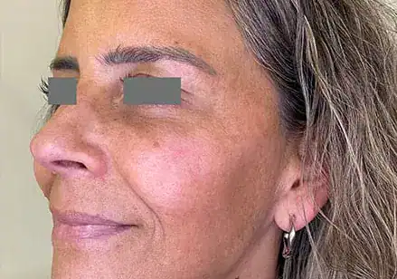 After Nordlys SWT treatment, Subject 5