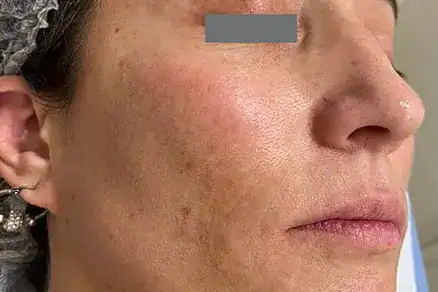 Before Nordlys SWT treatment, Subject 2