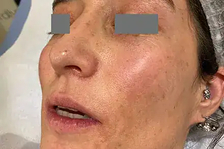 Before Nordlys SWT treatment, Subject 3