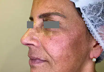 Before Nordlys SWT treatment, Subject 5